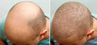 Sapphire Hair Clinic Hair Transplant Istanbul Consultation