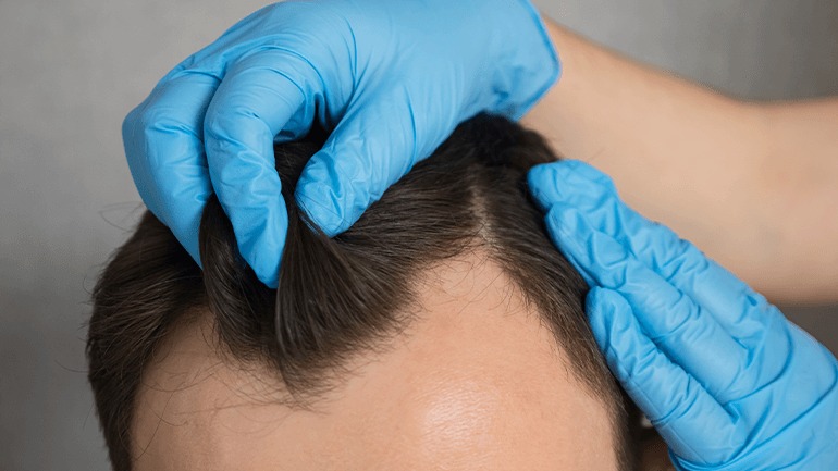 Hair Transplant Istanbul: Safe, Affordable, and Highly Effective