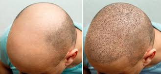 Sapphire Hair Clinic Hair Transplant Istanbul Consultation