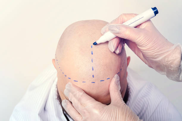 How Much Is Hair Transplant in 2026?